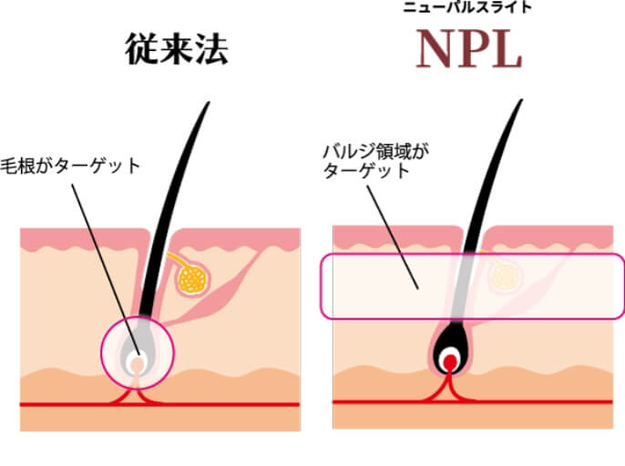 従来法とNPLの違いの図。従来法は毛根をターゲットにするのに比べ、NPL方式はバルジ領域ターゲットにする。
